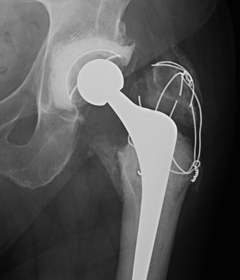 GT Osteotomy Broken Wires